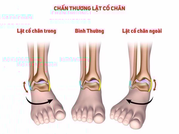 chan_thuong_lat_co_chan_1c72afafec804ff9bcbfbfd970315754_grande lat co chan